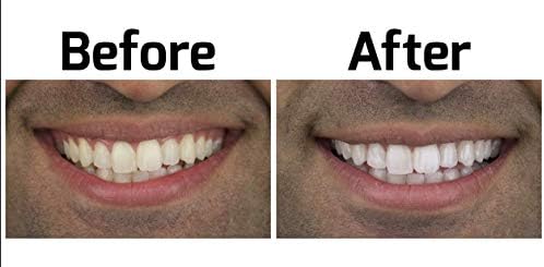 Комплект за избелване на зъби с опалесценцией. Най-добър избелващ продукт за по-бели зъби. Удобни тави Opalescence Go